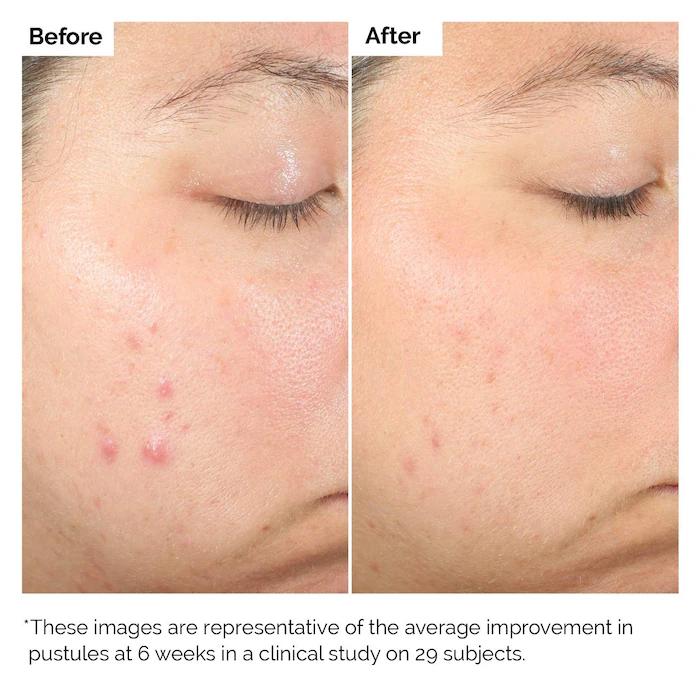 The Ordinary Salicylic Acid 2% Solution